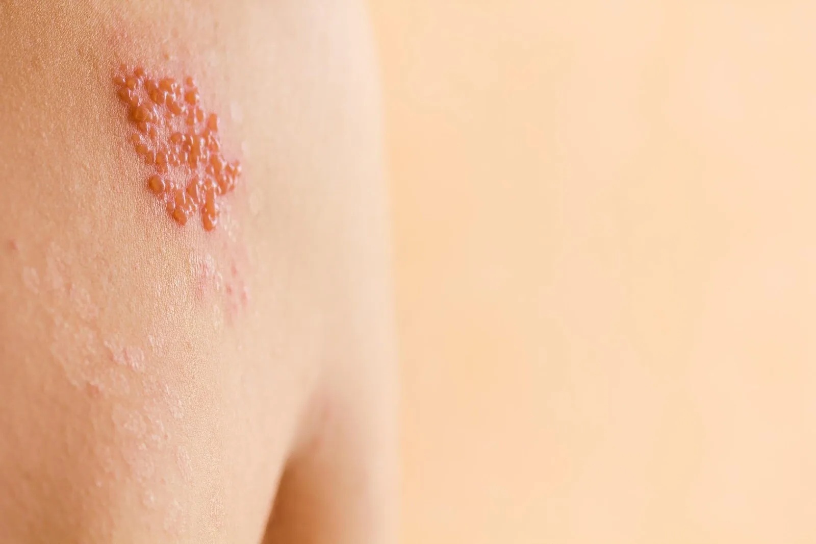 33 Fakta Tentang Herpes