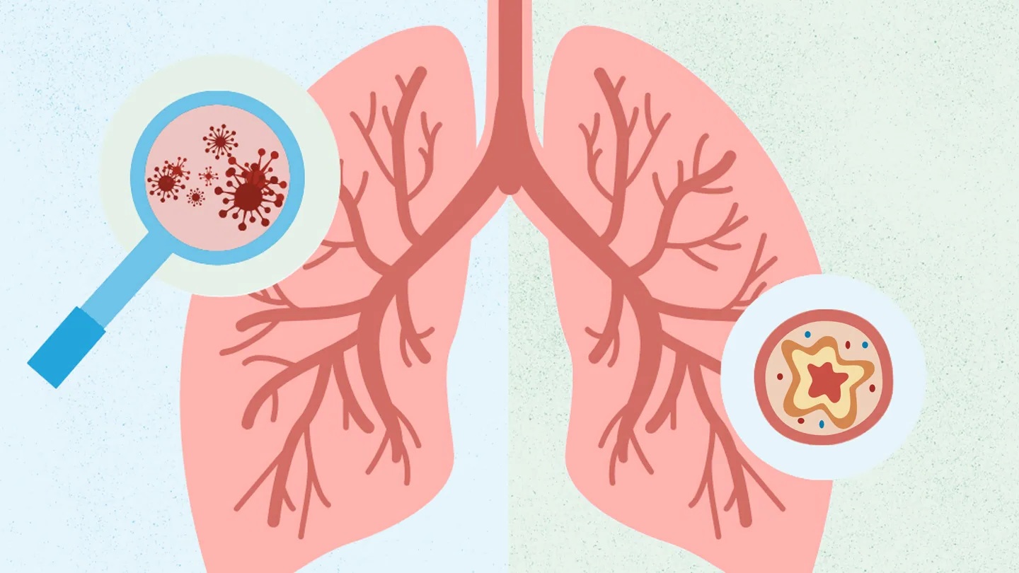 38 Fakta Tentang Bronkitis